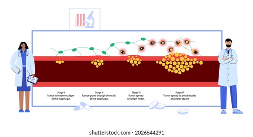 Stages of esophageal carcinoma in the human body. Internal organs exam in clinic. Inflammation, pain, tumor in the digestive system concept. Oesophagus cancer medical poster flat vector illustration.