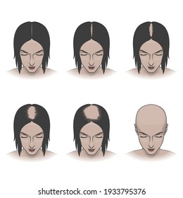 Stages Of Female Hair Loss, Treatment And Hair Care