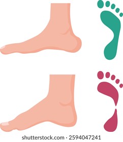 stages of flat foot vector 