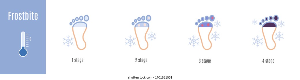 Stages Of Foot And Fingers Frostbite. Hypothermia. Medical Infographic