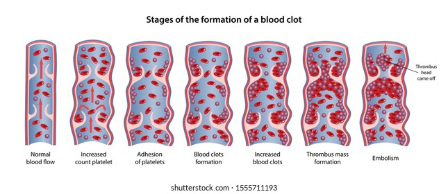 877 Blood clotting diagram Images, Stock Photos & Vectors | Shutterstock