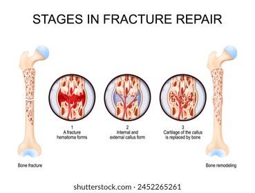 Stages in fracture repair. From Bone fracture and hematoma forms to Cartilage of the callus is replaced by bone and Bone remodeling. Vector illustration