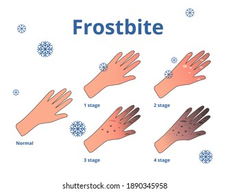 Frostbite Hd Stock Images Shutterstock