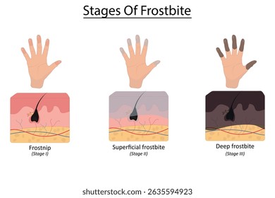 Stages of frostbite vector illustration
