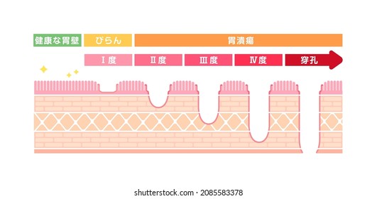 Stages of gastric ulcer ( stomach ulcer ) vector illustration. Translation: Inside, Tumor, Mucosa, Submucosa, Muscle, Subserosa, Serosa, Outside, Normal, Erosion, Ulcer, Stage, Perforated ulcer.