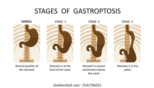 Stages of gastroptosis. Dropped stomach