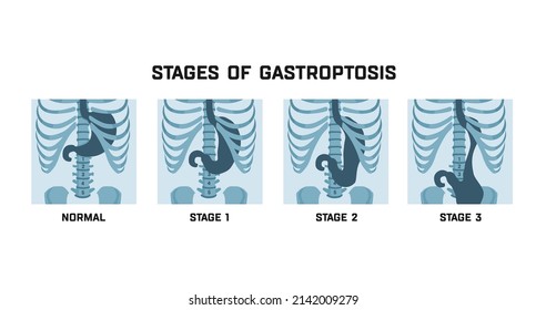 Stages of gastroptosis. Dropped stomach. Shapes and positions of the stomach