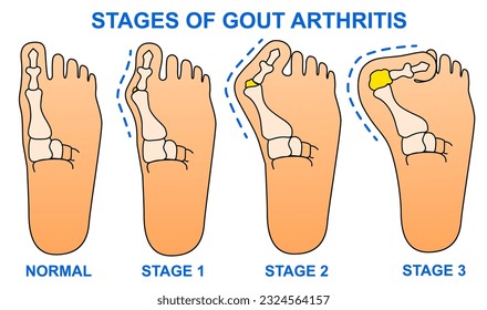 Stadien der Gicht-Arthritis. Spring auf das Bein! Fuß mit Gicht. Hallux valgus. Illustration im Gesundheitswesen. Vektorgrafik