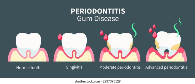 Stages of gum disease, dental concept. Stage of development of dental periodontitis. Vector concept dental health.