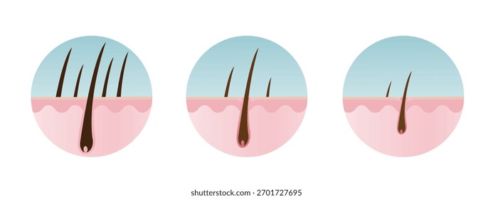 Estágios de perda de cabelo com ícone de vetor de camada escalpo conjunto ilustração isolado no fundo branco. Reduzir, diminuir, fino, cair, cabelo fraco da raiz para alopecia e calvície. Cuidados com o cabelo e conceito de anatomia.