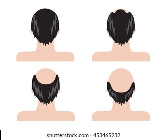 Stages of hair loss . bald man