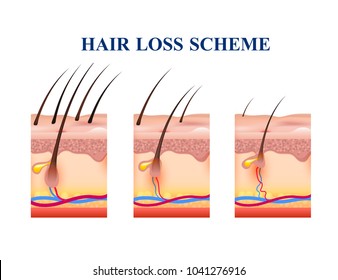 Etapas de pérdida de cabello en la piel humana, esquema con estructura anatómica incluyendo folículos, venas, nervios, ilustración vectorial 