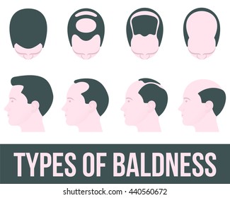 Stages of hair loss and hair treatment, vector illustration flat is isolated on a white background. different stages of hair loss