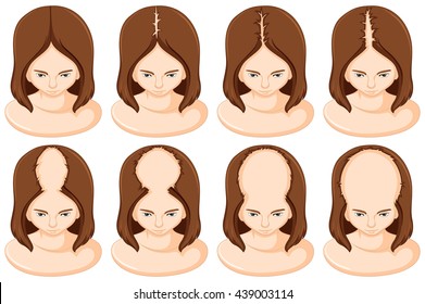 Stages Of Hair Loss In Woman