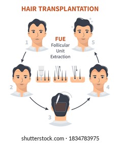 Stages Of Hair Transplantation FUE Follicular Unit Extraction. Treatment Of Baldness, Alopecia, Mens Hair Loss. Vector Medical Circle Infographics, A Male Head Scalp. Strip, Graft Machine.