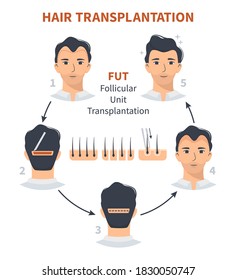 Stages Of Hair Transplantation FUT Follicular Unit. Treatment Of Baldness, Alopecia, Mens Hair Loss. Vector Medical Circle Infographics, A Male Head Scalp. Strip, Graft Machine.