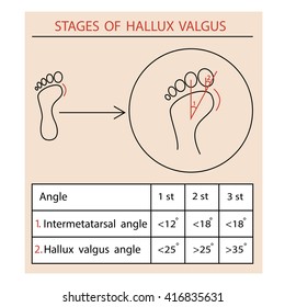 Stages Of Hallux Valgus