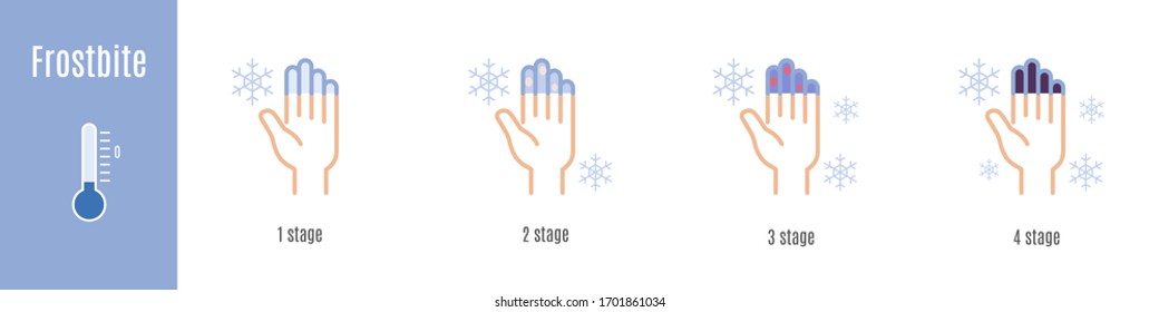 Stages of hand and fingers frostbite. Hypothermia. Medical infographic