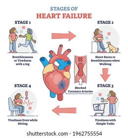 Stages Of Heart Failure And Symptoms With Cardiology Stroke Outline Diagram. Educational Labeled Guide With Medical Problem Symptoms And Cardiac Arrhythmia Or Attack Recognition Vector Illustration.