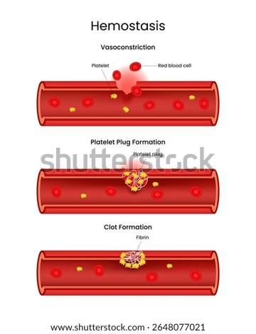 Stages of Hemostasis Vasoconstriction, Platelet Plug, and Clot Formation