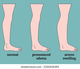 Stages of human leg edema. Medical background or poster. Vector flat illustration svg