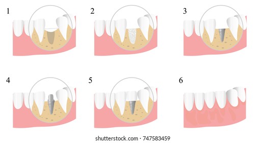 stages of implantation of teeth. Vector illustration