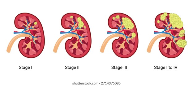 Estágios do Câncer de Rim. Rim normal e Rim com câncer. Ilustração médica vetorial
