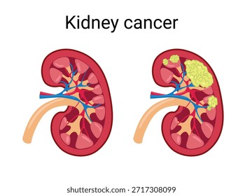 Estágios do Câncer de Rim. Rim normal e Rim com câncer. Ilustração médica vetorial

