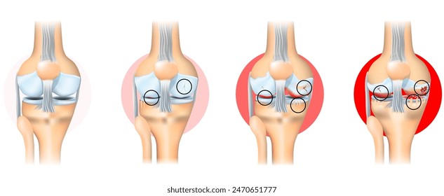 Stages of knee joint osteoarthritis. From Minimum disruption to lost a cartilage and joint-space reduction. Anatomy of knee joint. Vector illustration