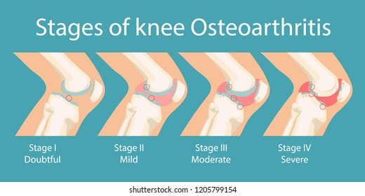 Stages of knee Osteoarthritis. Human Knee Osteoarthritis infographics. Vector illustration. 