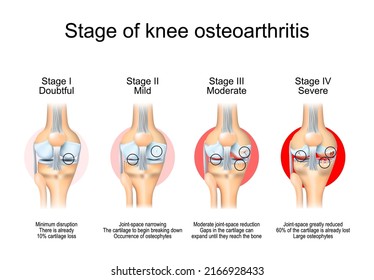 Stages of knee osteoarthritis. From Minimum disruption to lost a cartilage and joint-space reduction. Anatomy of knee joint. Vector illustration