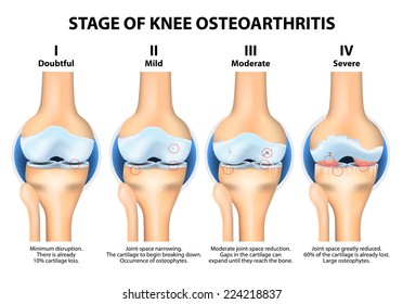 Stages Of Knee Osteoarthritis (OA)