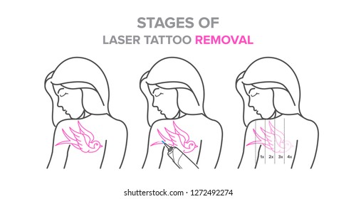 Stages of laser tattoo removal, vector illustrations. For your design