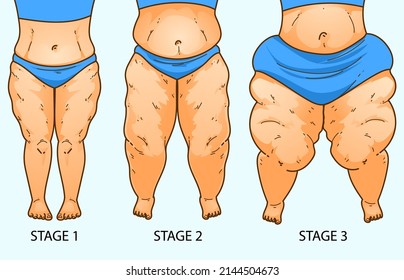 Stages of the lipedema. Women's legs with health problems. Healthcare illustration, medical infographics. Vector illustration. svg