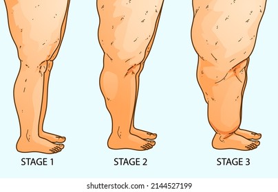 Stages of the lipedema. Women's legs with health problems. Healthcare illustration, medical infographics. Vector illustration. svg