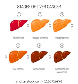 Stages Liver Damage Concept Vector Illustration Stock Vector (Royalty ...