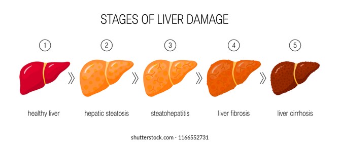 Stages of liver damage concept. Vector illustration of healthy liver, steatosis, NASH, fibrosis and cirrhosis in cartoon style