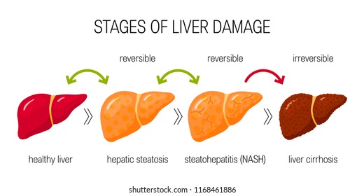 Stages of liver damage concept. Vector illustration of reversible and irreversible liver conditions in flat style