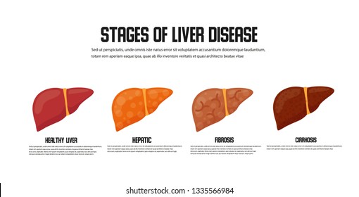 118 Nonalcoholic fatty liver disease Images, Stock Photos & Vectors ...