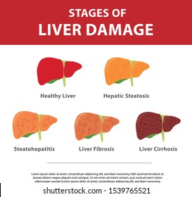 Stages Liver Damage Concept Vector Illustration Stock Vector (Royalty ...