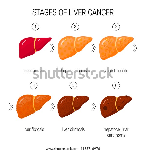 Stages Liver Damage Concept Vector Illustration Stock Vector (Royalty ...