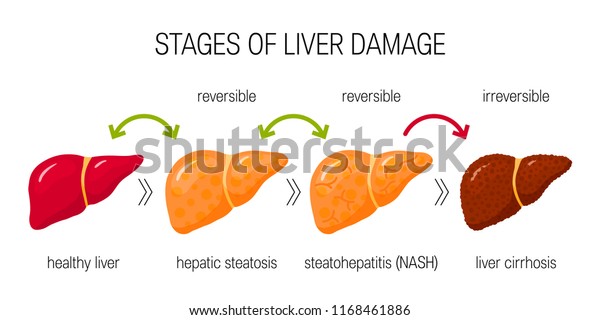 Stages Liver Damage Concept Vector Illustration Stock Vector (Royalty ...