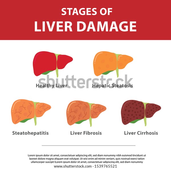 Stages Liver Damage Concept Vector Illustration Stock Vector (Royalty ...