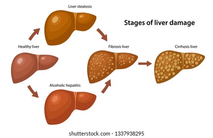 Royalty-free Stages of liver damage. Liver Disease. Healthy ...