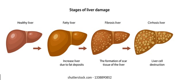 Stages Of Liver Fibrosis