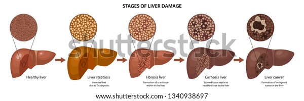 Stages Liver Damage Description Corresponding Steps Stock Vector Royalty Free 1340938697