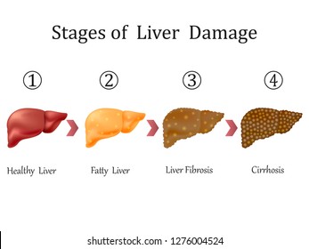 Stages of liver damage, liver disease. Healthy, fatty, liver fibrosis and cirrhosis isolated on white background.Vector illustration