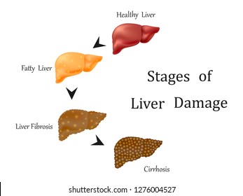 Stages of liver damage, liver disease. Healthy, fatty, liver fibrosis and cirrhosis isolated on white background.Round diagram.Vector illustration