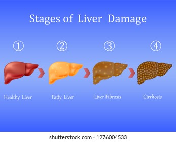 Stages of liver damage, liver disease. Healthy, fatty, liver fibrosis and cirrhosis isolated on blue background.Vector illustration