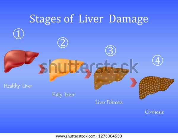 Stages Liver Damage Liver Disease Healthy Stock Vector (Royalty Free ...